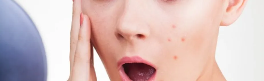 Tratamiento natural del acne Tratamiento Natural del acné