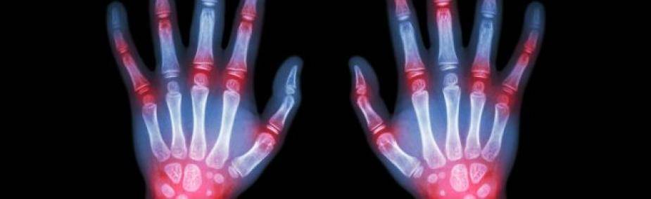 Artritis reumatoide tratamiento natural