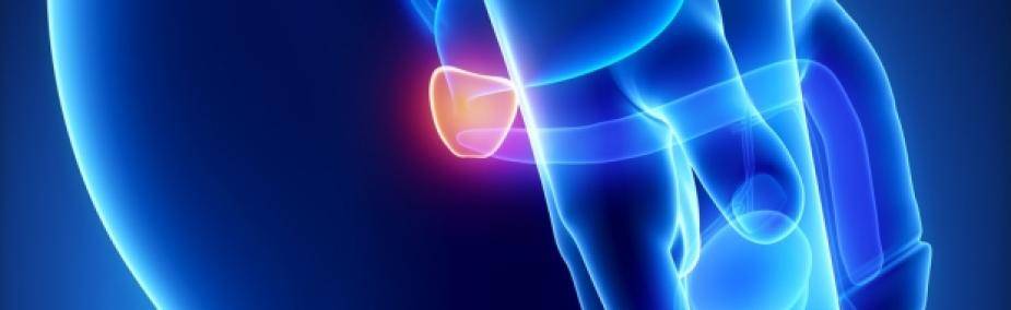 Cáncer de Próstata Tratamiento Natural
