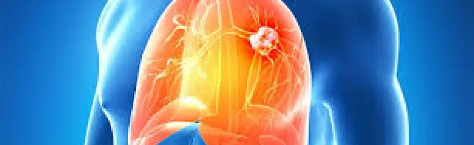 Cáncer de Pulmón Tratamiento Natural Tratamiento Natural para el cáncer de pulmón