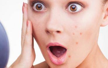 Tratamiento Natural del acné