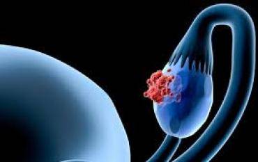 Tratamiento Natural para el Cáncer de Ovario