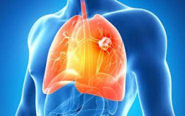 Tratamiento Natural para el cáncer de pulmón